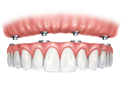 All-On-4 Implant Supported Dentures in Bethesda, MD