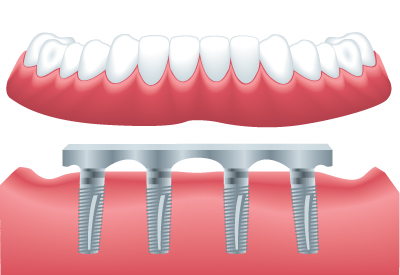 Bar-Retained Dentures in Bethesda, MD