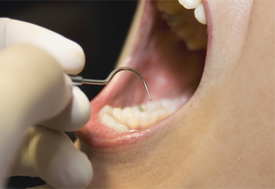 Periodontal Maintenance in Bethesda, MD