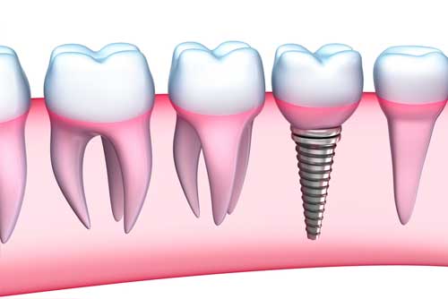 Replace Missing Teeth in Bethesda, MD