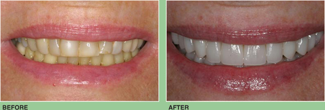 Full Mouth Porcelain Veneers and Crowns