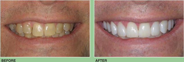 Six Porcelain Veneers