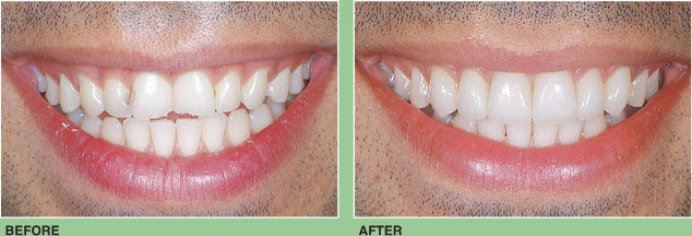 Six Porcelain Veneers