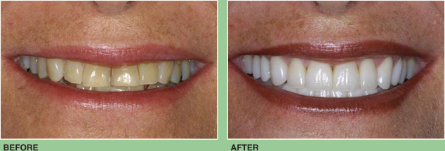 Ten Porcelain Veneers