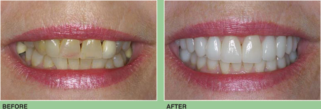 All Porcelain Veneers and Crowns